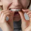 Retention procedures for stabilising tooth position after treatment with orthodontic braces